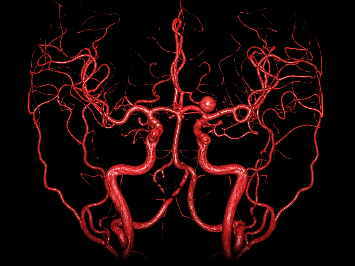 Tratamiento de aneurismas cerebrales en CDMX y Guadalajara