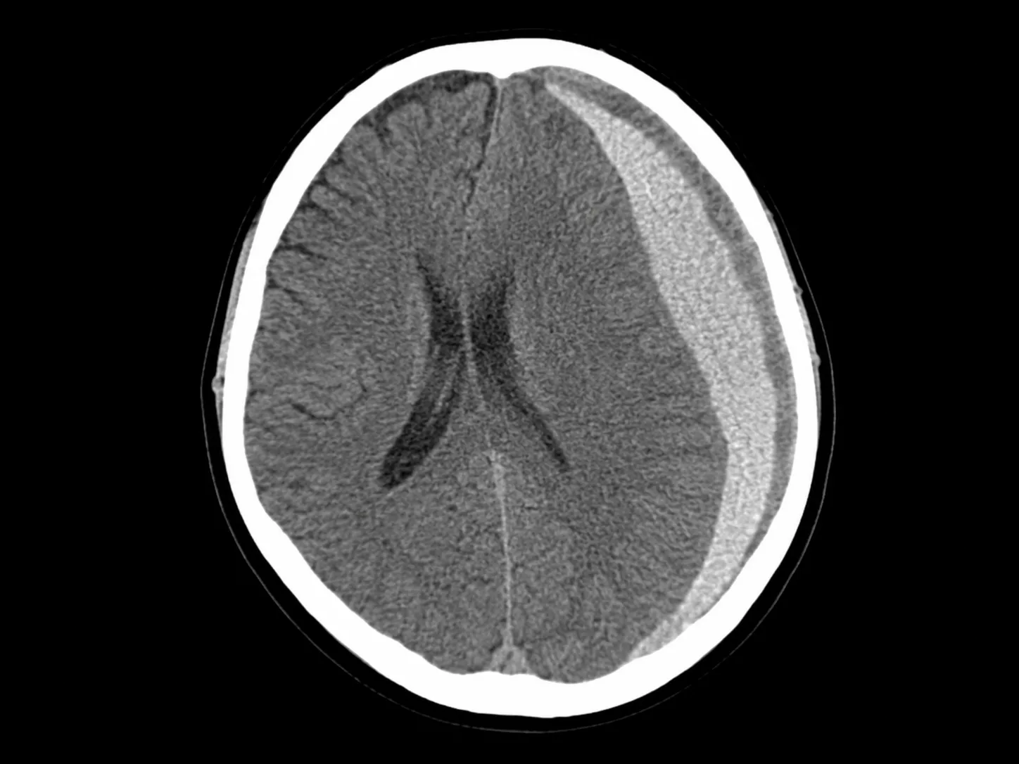Tratamiento de hematoma subdural en CDMX y Guadalajara