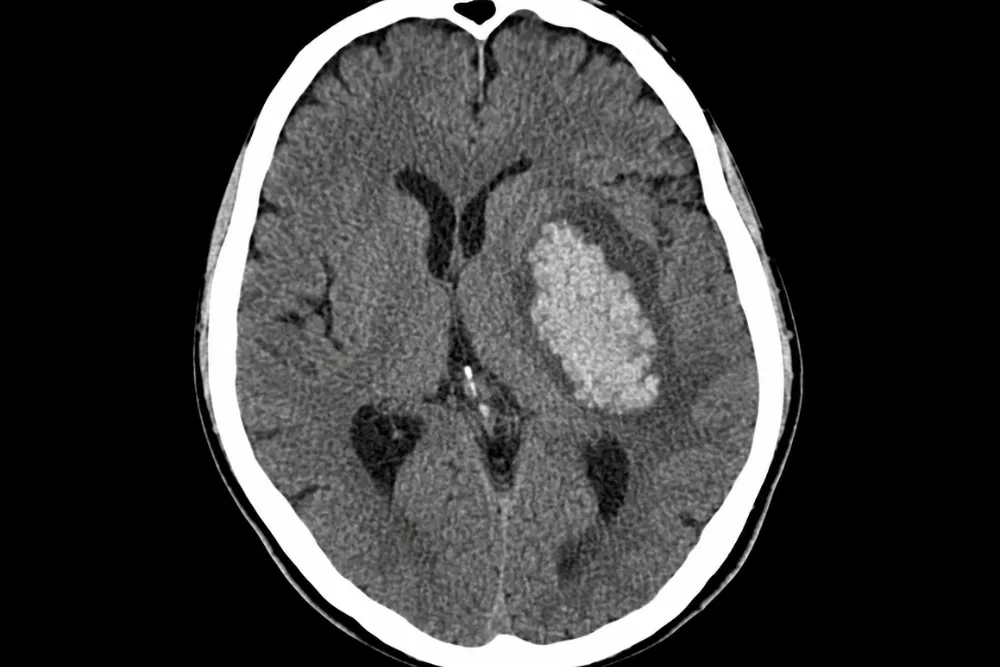 Tratamiento de hemorragias cerebrales en CDMX y Guadalajara